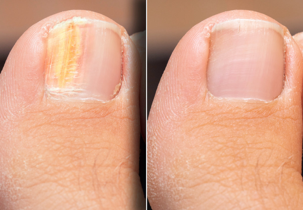close up of before and after nail fungus onychomycosis treatment