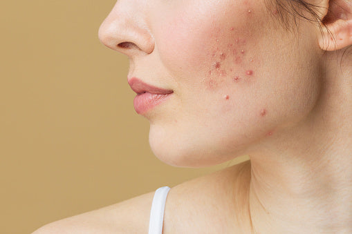 acne, clear skin, probiotics and acne, integrative treatments for acne