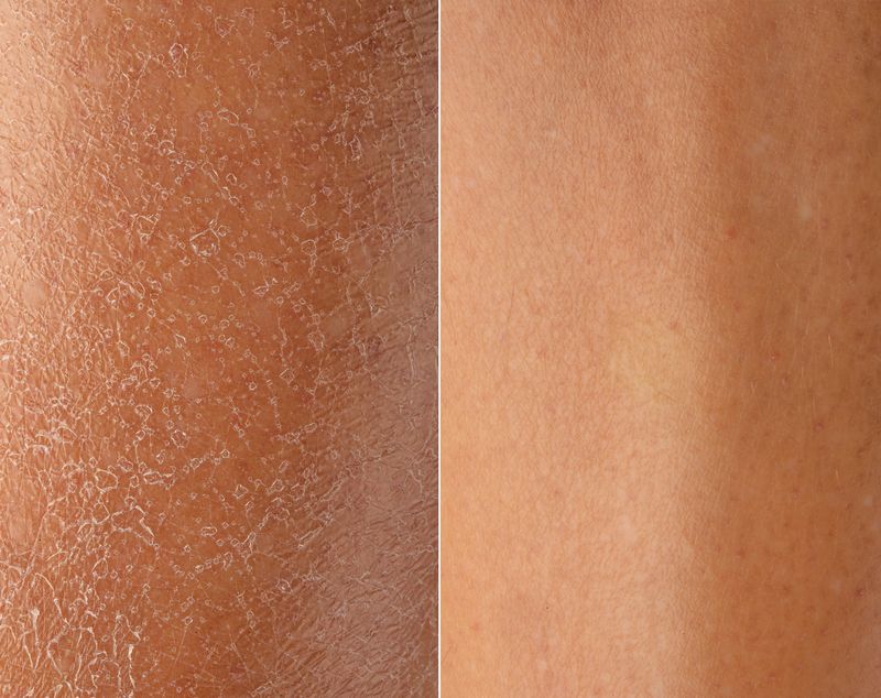 Before and after of damaged skin with eczema treatment. Atopic dermatitis 