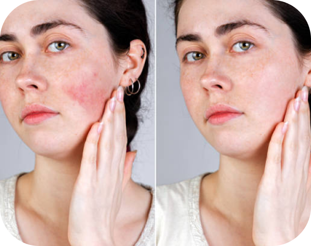 Before and after of rosacea treatment skin care from dermatologists 
