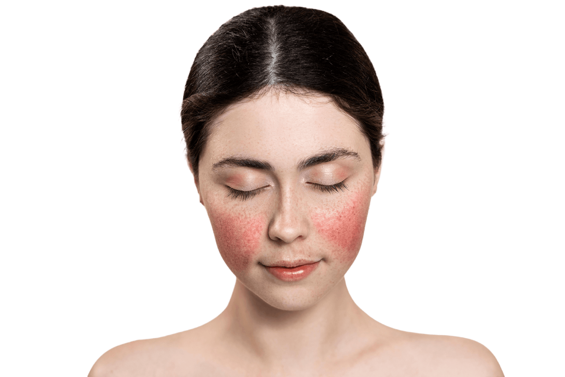 Close up of young woman with rosacea skin condition red skin
